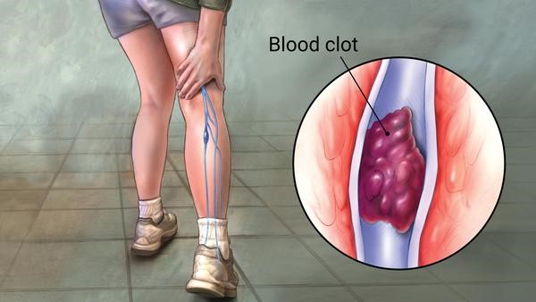 DVT - Blood Clots - The RANE Center for Venous and Lymphatic