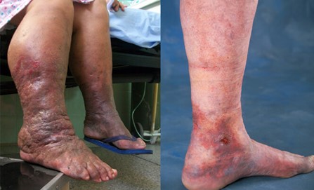 Post thrombotic syndrome- non healing ulcer