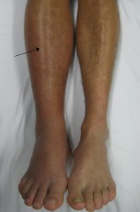leg swelling dvt