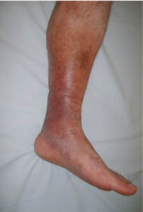 leg swelling
