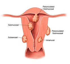 multiple fibroids