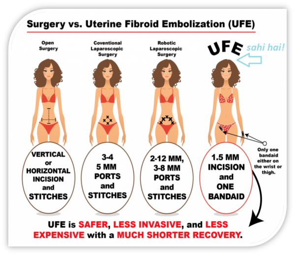 firbroid embolization or surgery
