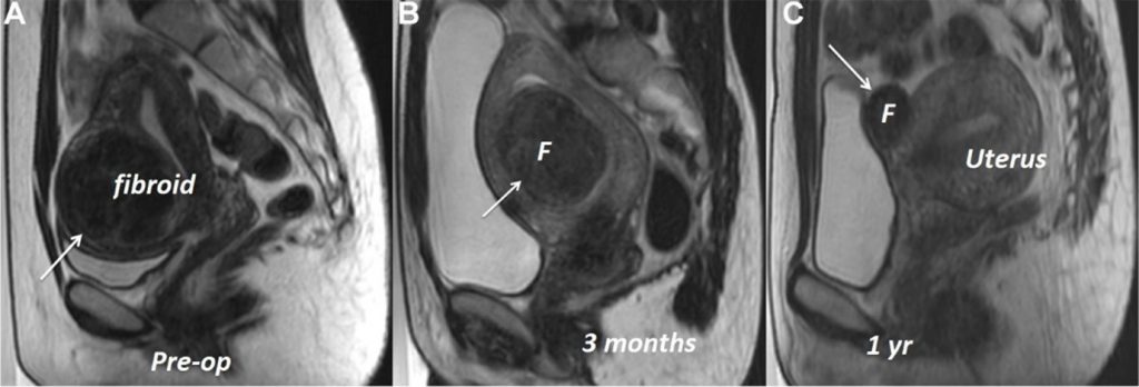MRI images showing how fibroids size got soften and significantly reduced.