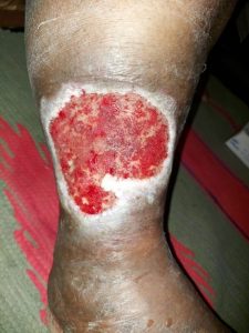 ulcer on leg