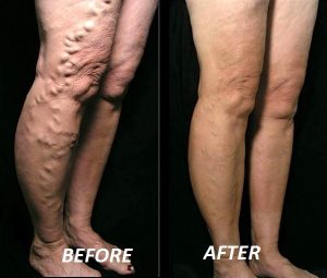 varicose veins best therapy