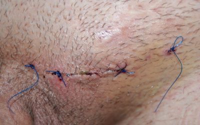 scar marks after surgery