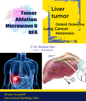 liver tumor local treatment