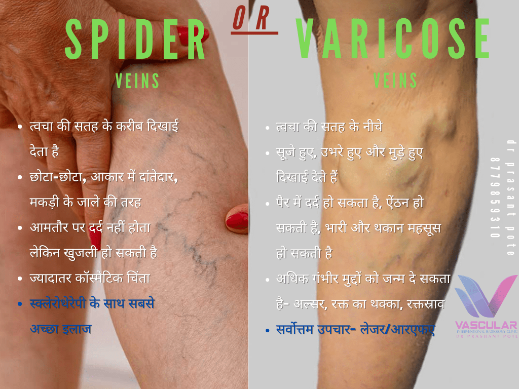 Spider veins or Varicose Veins