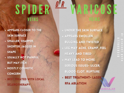 7 spider vs varicose
