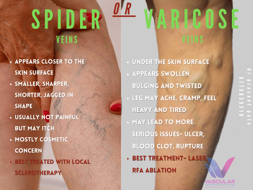Spider vs Varicose Veins Eng
