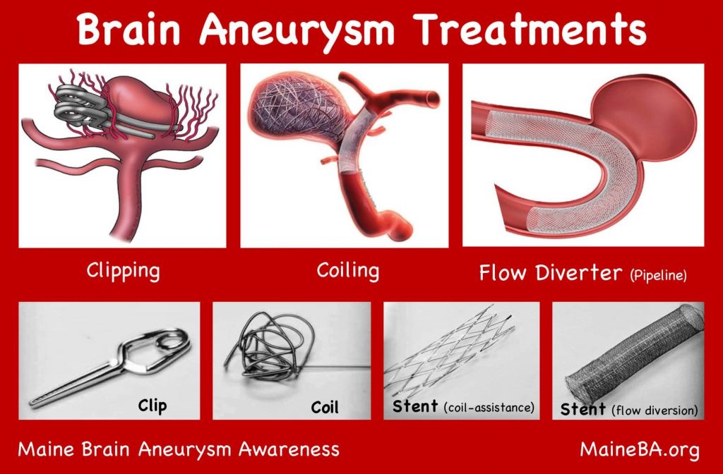 Brain Aneurysm Treatment