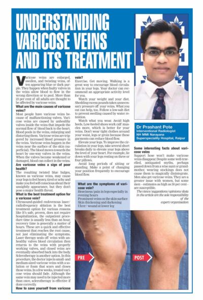 TOI Varicose vein 1