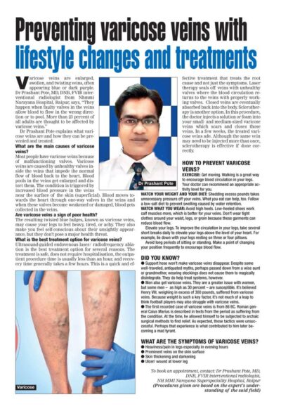 TOI varicose vein 2