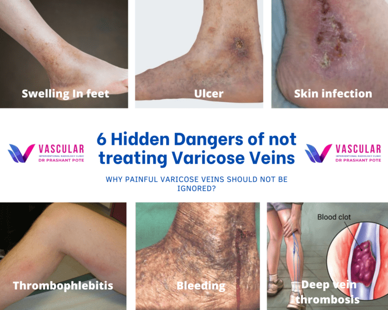 varicose leg ulcer