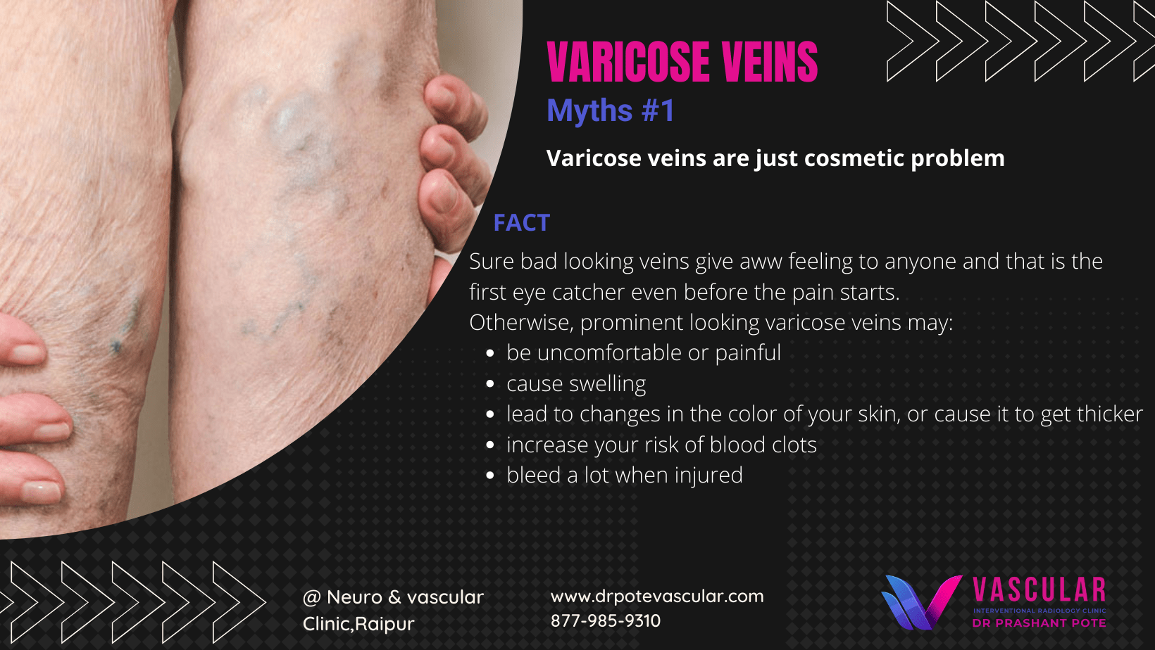 Varicose Veins & Venous Diseases - Vascular Info